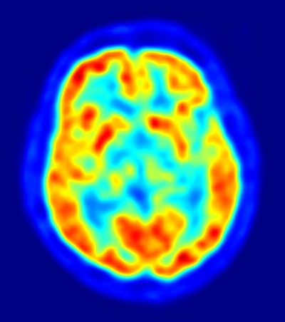 PET scan of a healthy brain