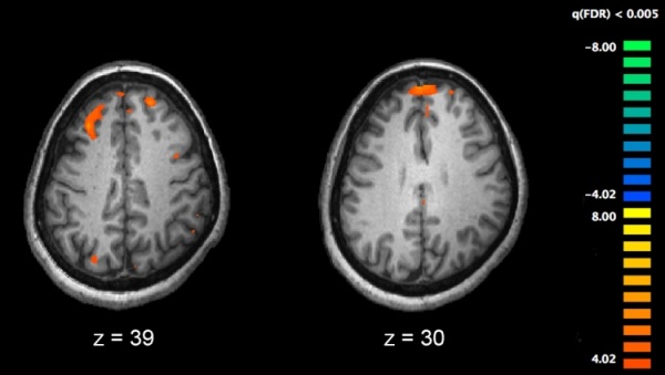 fMRI of a Healthy Brain (Left) and a Schizophrenic Brain