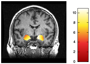 fMRI image showing activity level of the amygdala.