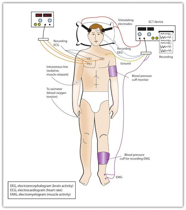 Electroconvulsive Therapy (ECT)