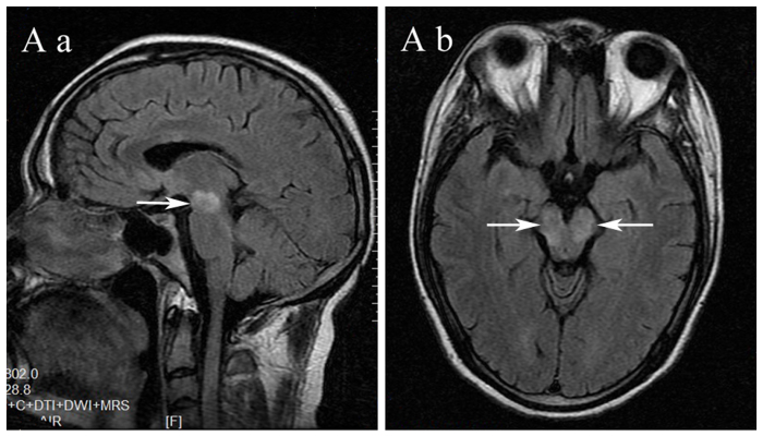 MRI showing brain stem lesions