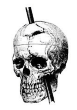 Areas in the frontal lobe of Phineas Gage were damaged when a metal rod blasted through it. Although Gage lived through the accident, his personality, emotions, and moral reasoning were influenced. The accident helped scientists understand the role of the frontal lobe in these processes.