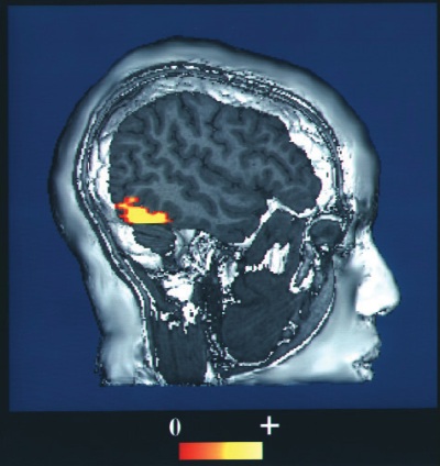 The fMRI creates images of brain structure and activity. In this image the red and yellow areas represent increased blood flow and thus increased activity. From your knowledge of brain structure, can you guess what this person is doing?