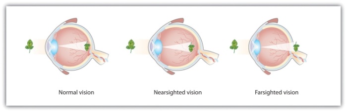 For people with normal vision (left), the lens properly focuses incoming light on the retina. For people who are nearsighted (center), images from far objects focus too far in front of the retina, whereas for people who are farsighted (right), images from near objects focus too far behind the retina. Eyeglasses solve the problem by adding a secondary, corrective, lens.