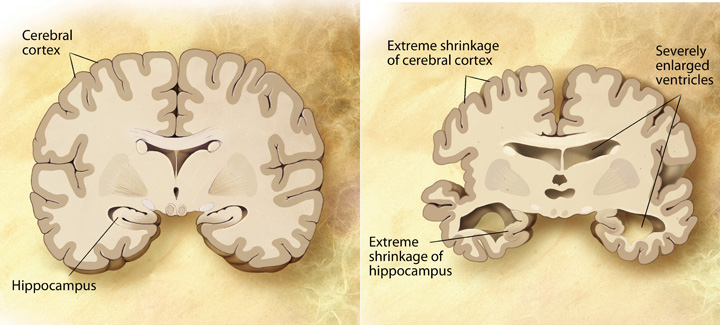 A Healthy Brain (Left) Versus a Brain With Advanced Alzheimer’s Disease (Right)